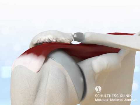 «Impingement Syndrom» - Schulthess Klinik