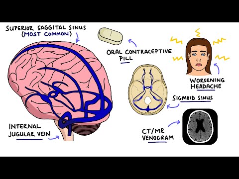 Seizures Seizure Types Generalized vs Focal Seizures Causes of Seizures Mnemonic