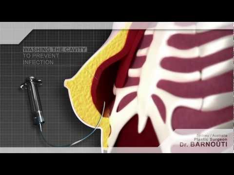 Chirurgie d'augmentation mammaire