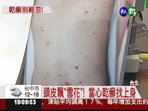 乾癬當頭皮屑 當心愈洗愈糟糕