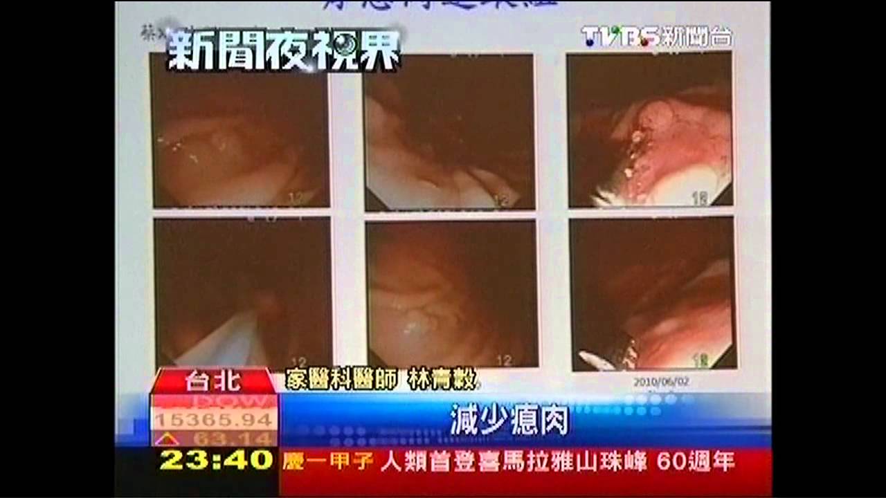 飲食不健康 國人大腸癌10倍增