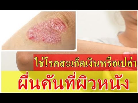 ยาสมุนไพรสำหรับกลาก การกำจัดของโรคสะเก็ดเงินบนหัว