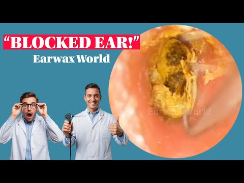 003- Extremely Hard to Remove Blocked Earwax | Deep Cleaning Extraction - Earwax World