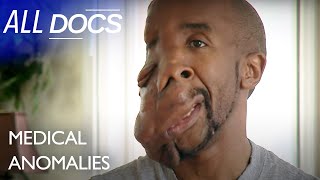Maurice&#39;s Brand New FACE | S01 E01 | Extraordinary People Documentary | All Documentary