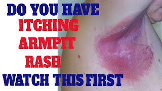Skin Rash | How To Get Rid Of Rash Under Armpit | Heat Rash | Eczema | Atopic Dermatitis | itchy