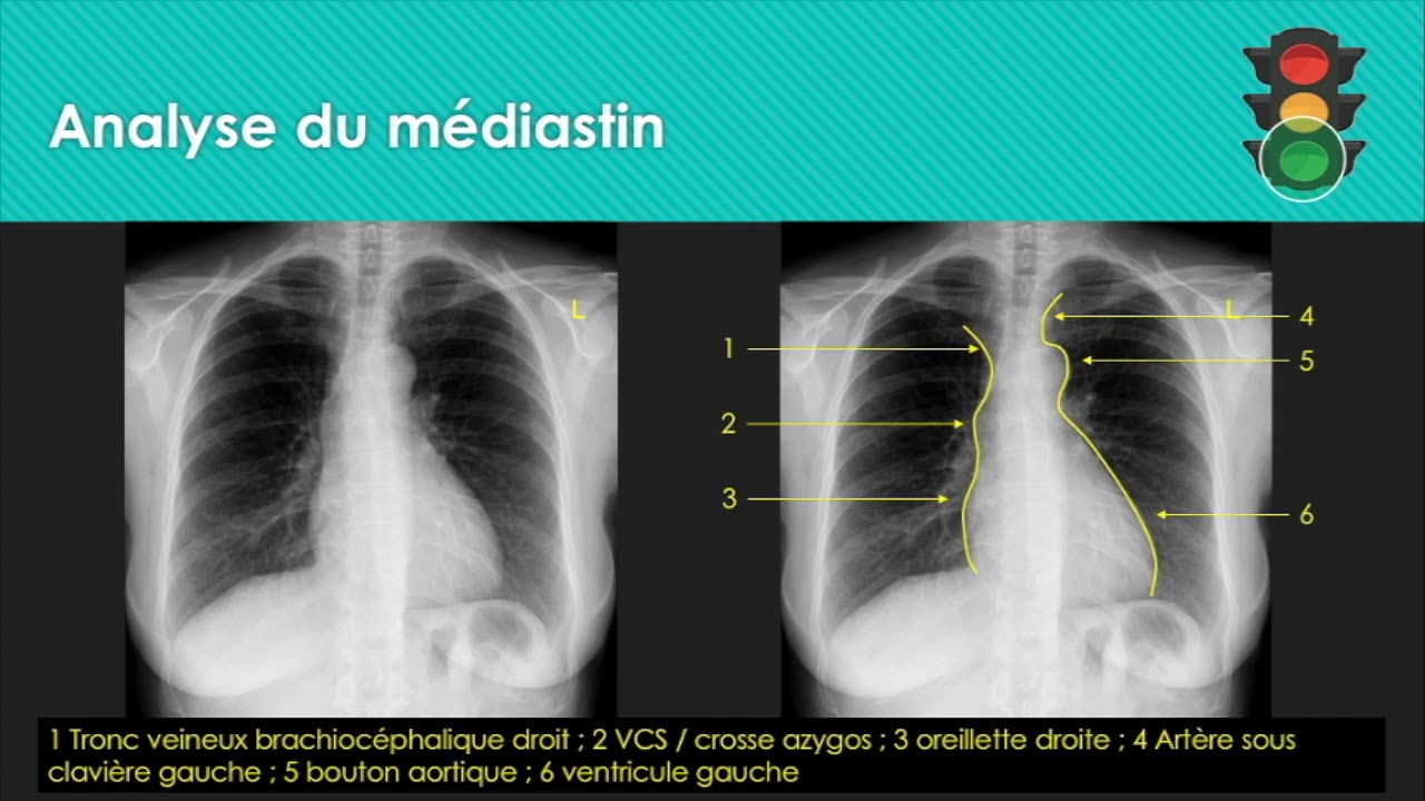 M1 Analyse de la radiographie thoracique (médiastin)