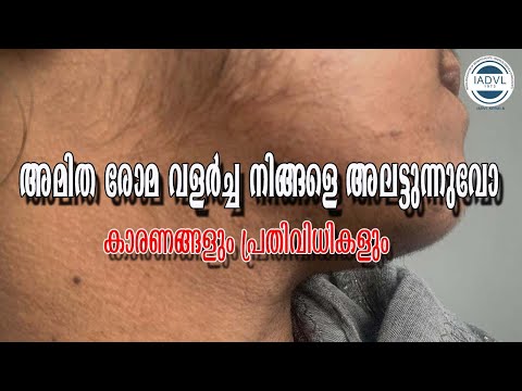 അമിത രോമ വളർച്ച നിങ്ങളെ അലട്ടുന്നുവോ - കാരണങ്ങളും 