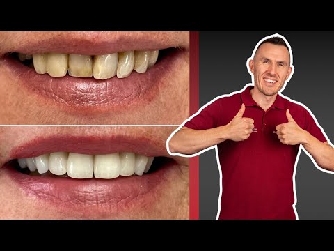 Schiefe Zähne richten durch überkronen Oder Veneers? Super Vorher-Nachher-Patientenfall!