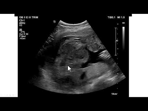 Descolamento prematuro da placenta. Achados ultrassonográficos e operatórios.