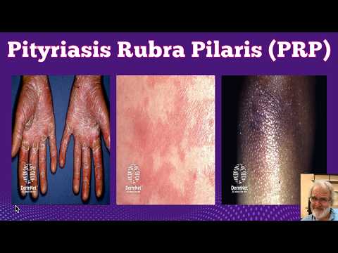 Parapsoriasis & Pityriasis Rubra Pilaris: The Grenz Zone Derm Podcast Episode 8 #dermatology #skin
