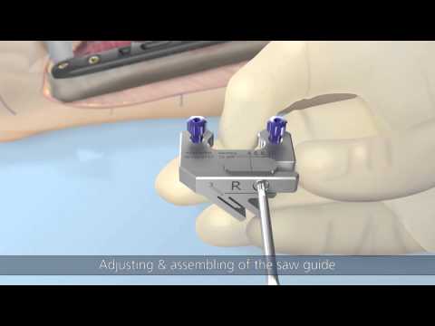 Recos® Ulna shortening by KLS Martin