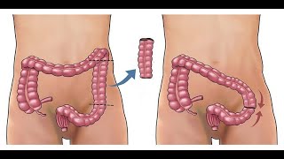 Sigmoid colectomy CPT code - simplify medical coding