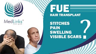 Advantages of FUE Hair Transplant Technique | MedLinks Hair Transplant in Delhi