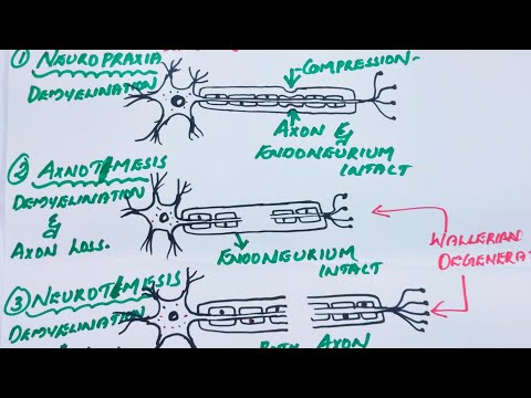 CLASSIFICATION OF PERIPHERAL NERVE INJURIES