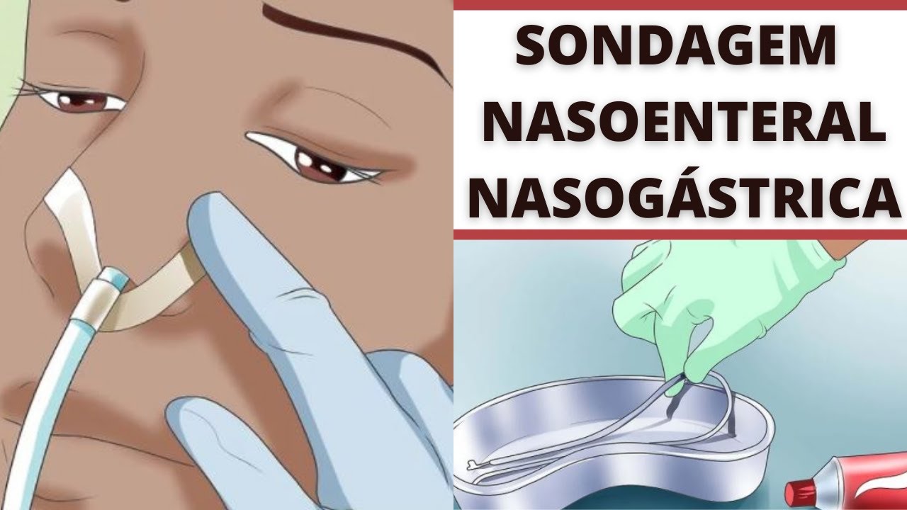 PROCEDIMENTO DE SONDAGEM NASOENTERAL E NASOGÁSTRICA