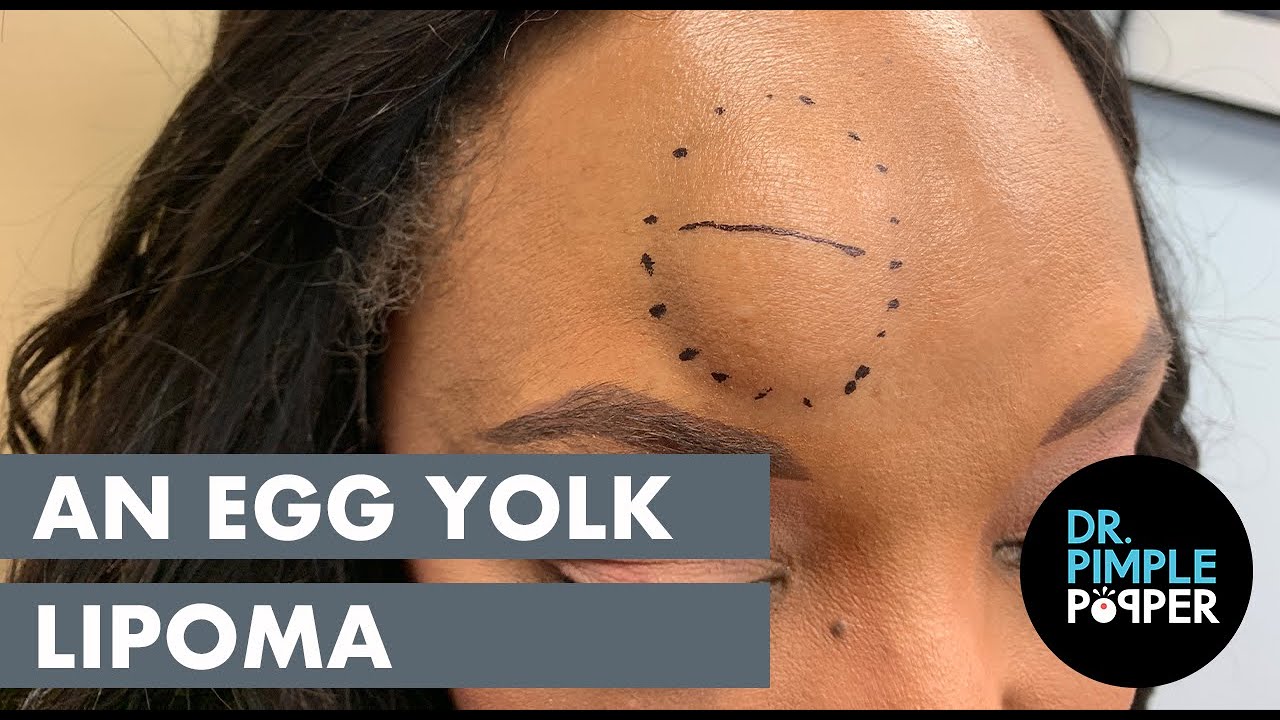 Watch Now An Egg Yolk Lipoma An Egg Yolk Lipoma