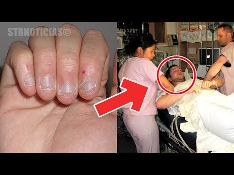 Luego de ver este vídeo ya no querrás morderte las uñas nunca más  ¡Las consecuencias son terribles! Video