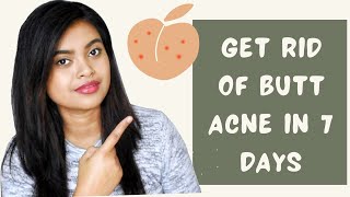 How to Get Rid of Butt Acne in 7 Days | Butt Acne Treatment | Natural Ways to Stop Butt Acne