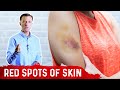 What Causes Bruises on Legs & Arms? – Top 5 Causes of Bruising Covered by Dr.Berg