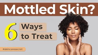 6 simple ways how you can treat your mottled skin. Causes and prevention #skincare #dermatology