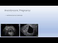 Miscarriage