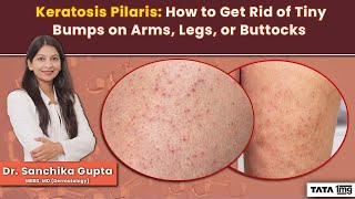 Keratosis Pilaris: How to Get Rid of Tiny Bumps on Arms, Legs or Buttoks by Dr Sanchika  #tata1mg