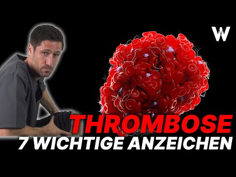 Lebensgefahr Thrombose: 7 Warnzeichen und wichtige Tipps gegen Thrombosen