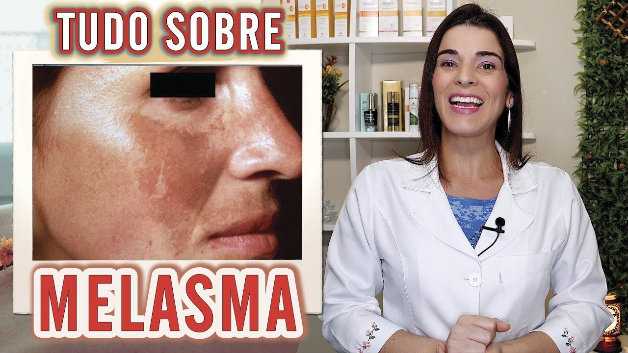 MELASMA - Como Clarear , Tratar e Prevenir essa Mancha de Pele !