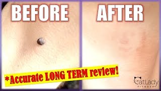 How to REMOVE A MOLE at home with Apple Cider Vinegar (STEP-BY-STEP DETAILS!) - Cat Lady Fitness