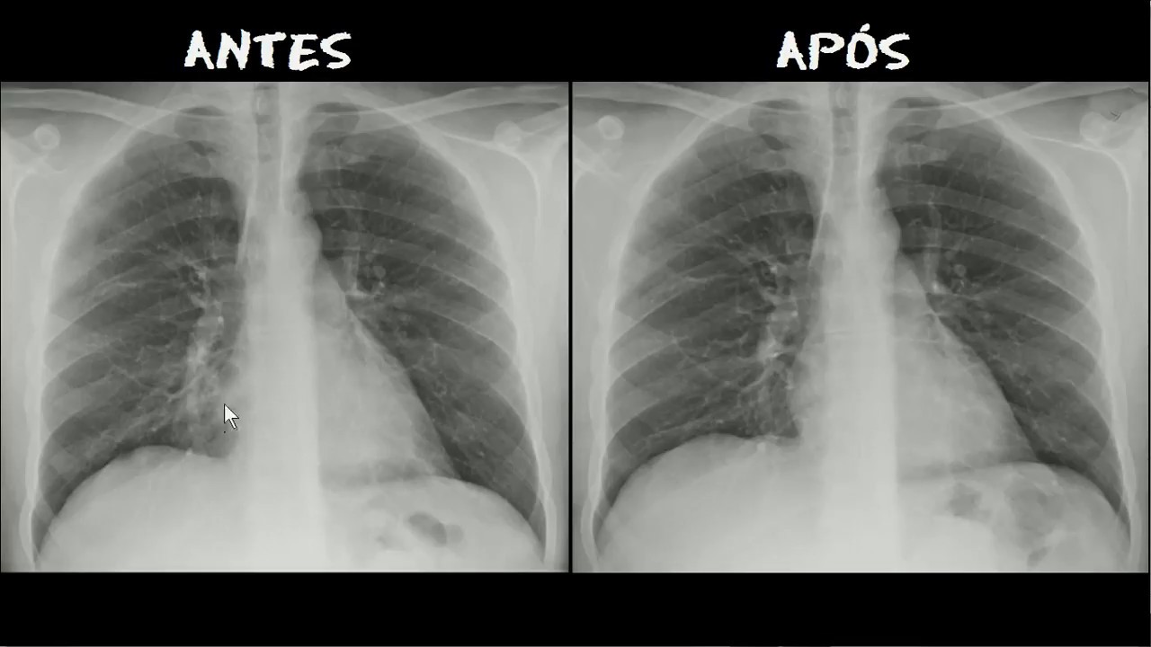 Pneumonia no Lobo médio