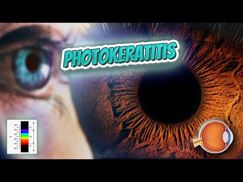 Photokeratitis - Your EYEBALLS - EYNTK 👁️👁️💉😳💊🔊💯✅