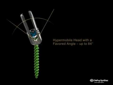 DepuySynthes: Expedium Verse Spine System Product Overview
