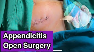 Appendicitis Surgery Open #2