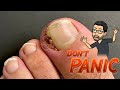CATASTROPHIC INGROWN TOENAIL