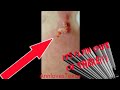 abscess / zit / cyst - huge pops! *blood and pus alert* - Ann in Texas abscess / zit / cyst - huge pops! *blood and pus alert*