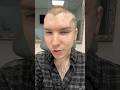 I Got A Facelift At 32 Years Old