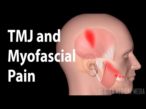 TMJ and  Myofascial Pain Syndrome, Animation.