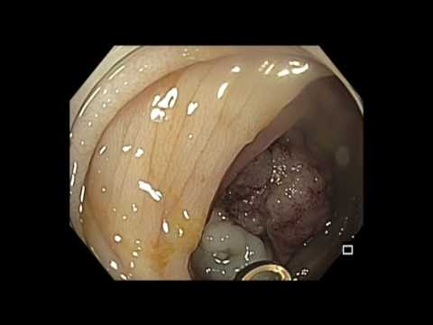 Colonoscopy: Rectosigmoid Giant Polyp Resection