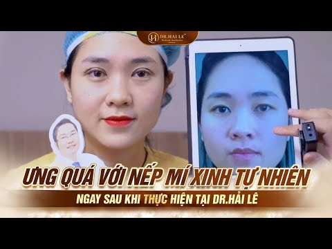 Ưng quá với nếp mí xinh tự nhiên ngay sau khi thực hiện tại Dr.Hải Lê