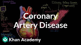 What is coronary artery disease? | Circulatory System and Disease | NCLEX-RN | Khan Academy