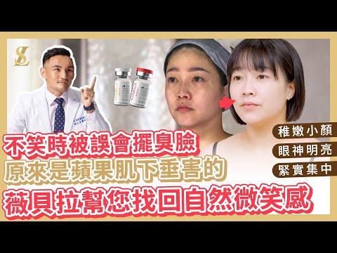【薇貝拉／魔法針】不笑時被誤會擺臭臉，原來是蘋果肌下垂害的!? 薇貝拉幫你找回自然微笑感！