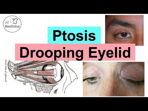 Ptosis (Drooping Eyelid) | Eye Anatomy, Causes, Associated Conditions, Diagnosis & Treatment
