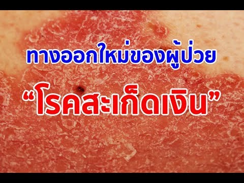 โคมไฟสำหรับโรคสะเก็ดเงินโรคสะเก็ดเงิน ufik สียาโรคสะเก็ดเงิน