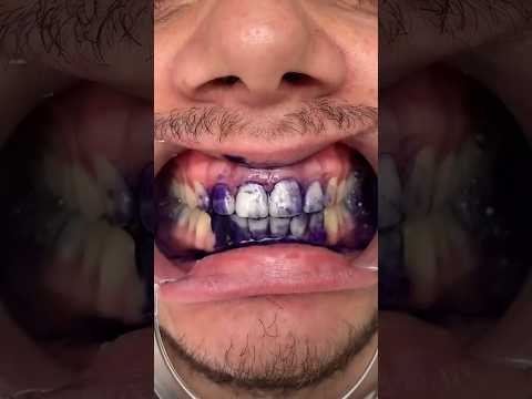 Mint Tooth Whiteners Cosmetic Third Party Manufacturing