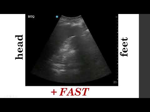 Introduction to eFAST Ultrasound for Medical Students