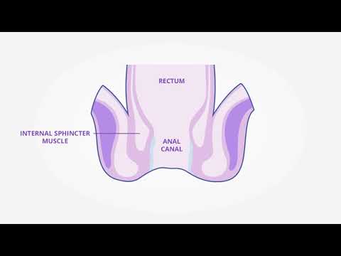 Applicators for Anal Fissure and other Anorectal Conditions - DoseRite