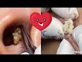 Ultimate Pimple Popping Compilation: Satisfying Extractions & Blackhead Removal | #PimplePopping