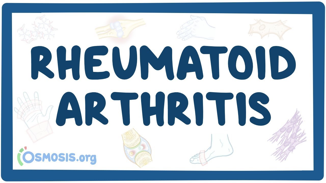 Rheumatoid arthritis - causes, symptoms, diagnosis, treatment, pathology