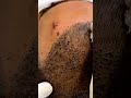 43M Views It S Not Just A Regular Head Wash Hair Transplant Clinic In Delhi