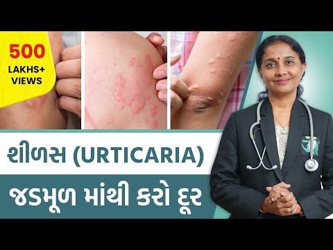 Ayurvedic Treatment Of Urticaria  | Dr. Devangi Jogal | JOGI Ayurved